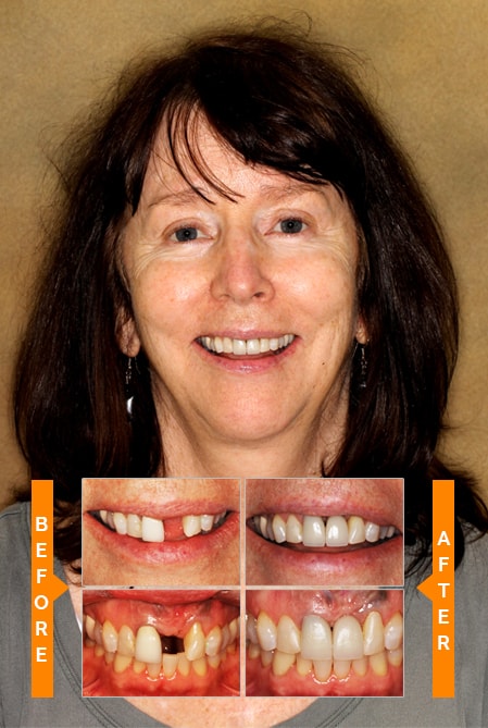 Our Patient Smile Gallery